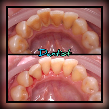 ПРОФЕСІЙНА ЧИСТКА ЗУБІВ