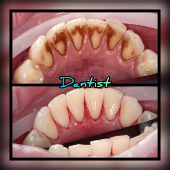 ПРОФЕСІЙНА ЧИСТКА ЗУБІВ