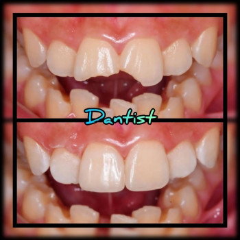 РЕСТАВРАЦІЯ ЗУБІВ