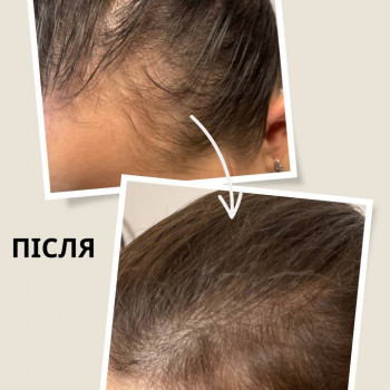 4 сеанси мікротокової терапії з наноозонованим маслом