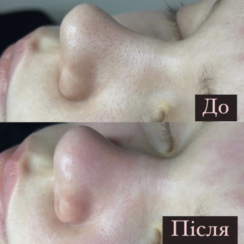 Чистка обличчя (комбінована)
                    Врач-косметолог Ксенія Ужгород