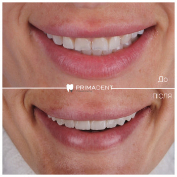 Вініри Керамічні
                    Стоматолог Максим Ужгород