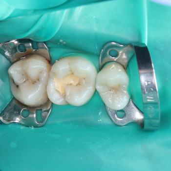 Лікування карієсу
                    Стоматолог Максим Ужгород