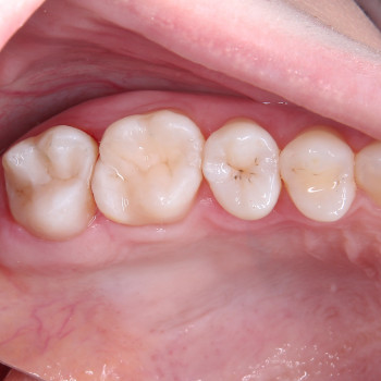 Лікування карієсу
                    Стоматолог Максим Ужгород