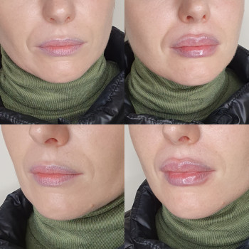 Рефрешинг губ
                    Лікар-косметолог Оксана Київ