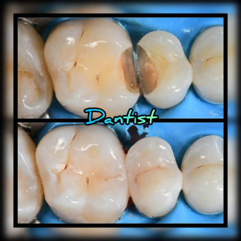 ЛІКУВАННЯ ЗУБІВ
    