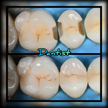 ЛІКУВАННЯ ЗУБІВ
    