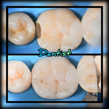 ЛІКУВАННЯ ЗУБІВ
    