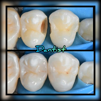 ЛІКУВАННЯ ЗУБІВ
    