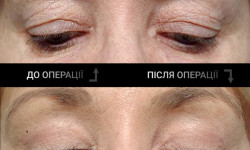 Блефаропластика Пластический хирург  Ужгород