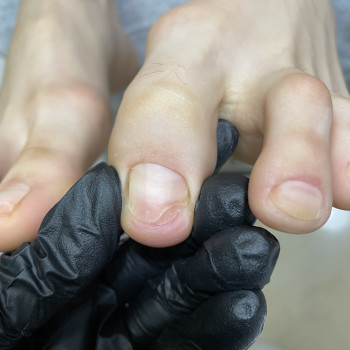 Оніхолізіс ПІСЛЯ чистки