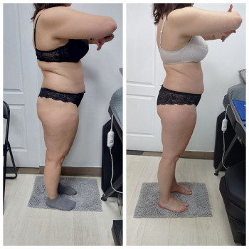 LPG Body Aesthetics, Бровари Фото - 7