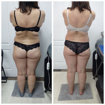 LPG Body Aesthetics, Бровари Фото - 21