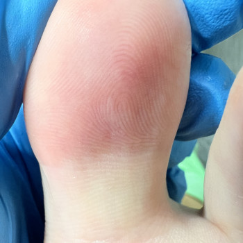 Повністю відновлений шкірний малюнок