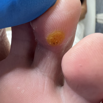 Після обробки хімічним методом