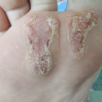Множинні папіломи на плюсні. 
Лікування подолог+онкодерматол