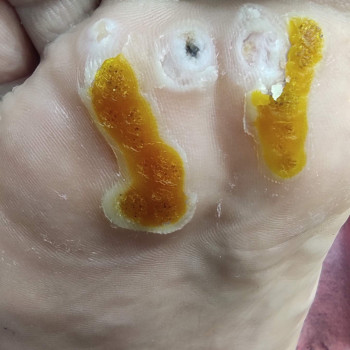 При великих обʼємах враження виготовляємо розвантаж. устілку