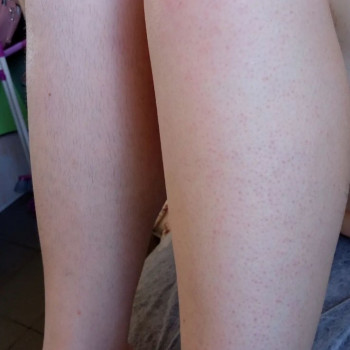 Воскова депіляція ніг