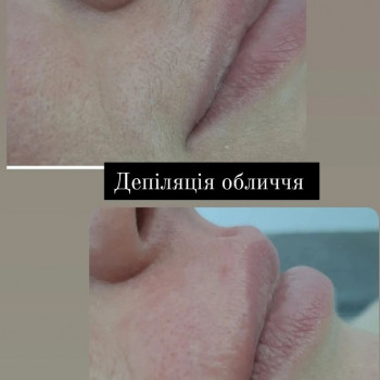 Депіляція обличчя воском
 
 
 