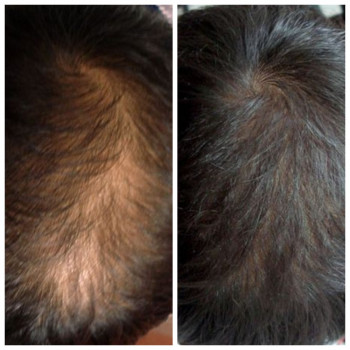 Лікування алопеції