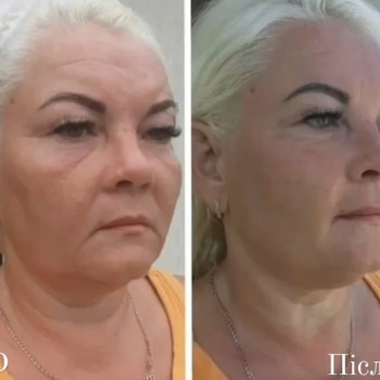 Sculptor lift massage + пілінг