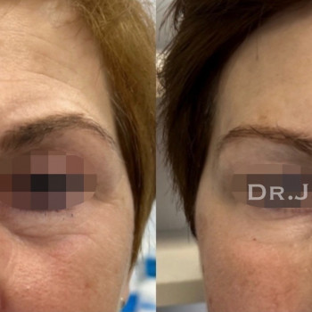 Віковий пацієнт пластичн.хірурга, але зробили корр.філером