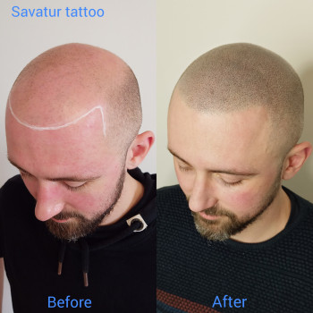 Трихопігментація, медичний татуаж голови, випадіння волосся