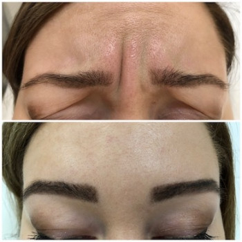 Ботулінотерапія