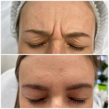 Ботулінотерапія