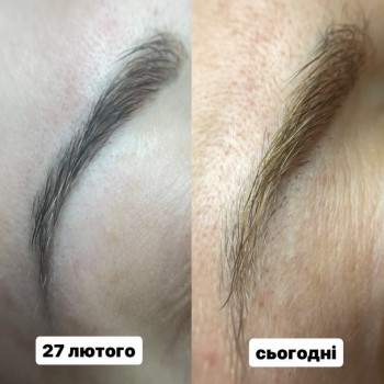 Видалення старого татуажу ремувером
                    Бровіст Елена Дніпро