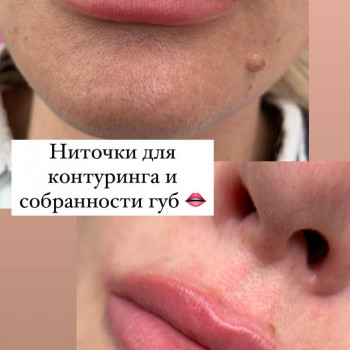 Ниткове армування
                    Дерматолог косметолог Виктория Александровна Кривий Ріг