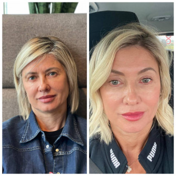 Ниткове армування: до та через 3 місяця