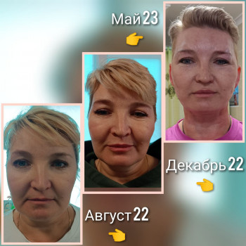 Ниткове армування
                    Дерматолог косметолог Виктория Александровна Кривий Ріг