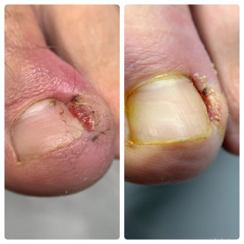 вросший ноготь