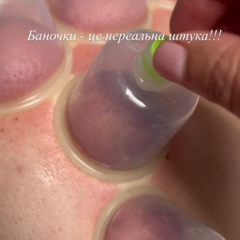 баночний масаж, масаж банками