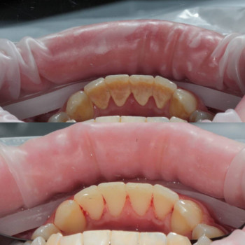 Огляд у пародонтолога для діагностики захворювань ясен.