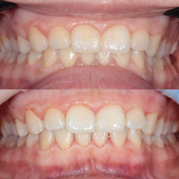 Лікування пародонтиту
                    Стоматолог Аліна Хмельницкий