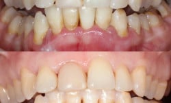 Професійна гігієна ротової порожнини зубів (Чистка зубів) Стоматолог Аліна Хмельницкий