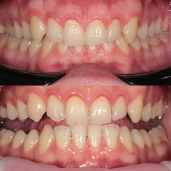 Гігієна ротової порожнини для здоров’я ясен та білизни зубів.