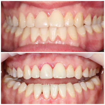 Видалення зубного каменю та нальоту під час гігієни зубів.