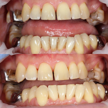 Процедура Air Flow для видалення пігментації з емалі.