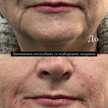 Інʼєкційна косметологія