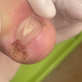 Первинне зняття больового синдрому при вростанні нігтьової пластини (перев‘язка 1-ша ступінь) консультація +план терапії
                    Подолог Лаура Киев