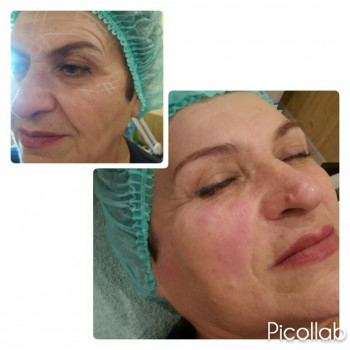 СМАС
 #Альтера Смас лифтинг
 #Ulthera SMAS