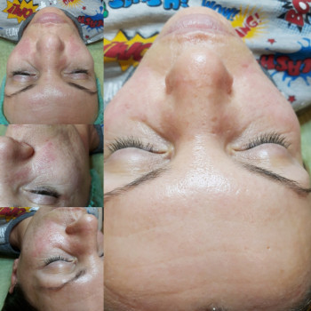 Пилинг
  Котовского Суворовский р-н