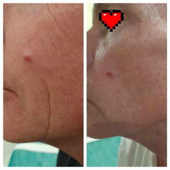 СМАС+ мезо
  СМАС Котовского Суворовский р-н 
  Котовского Суворовский р-н