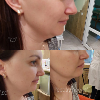 Результат сразу после процедуры СМАС
  лифтинг Котовского 
  второй подбородок
 