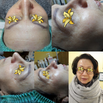 В процессе и сразу после процедуры.