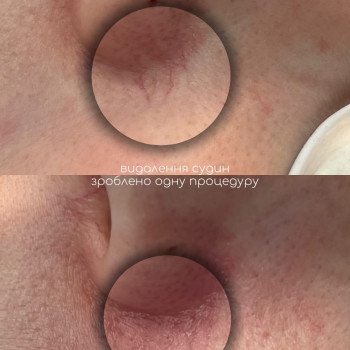 Видалення судин на обличчі