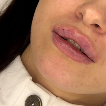 Фото з портфоліо косметолога Валерія Мельник (Полтава)